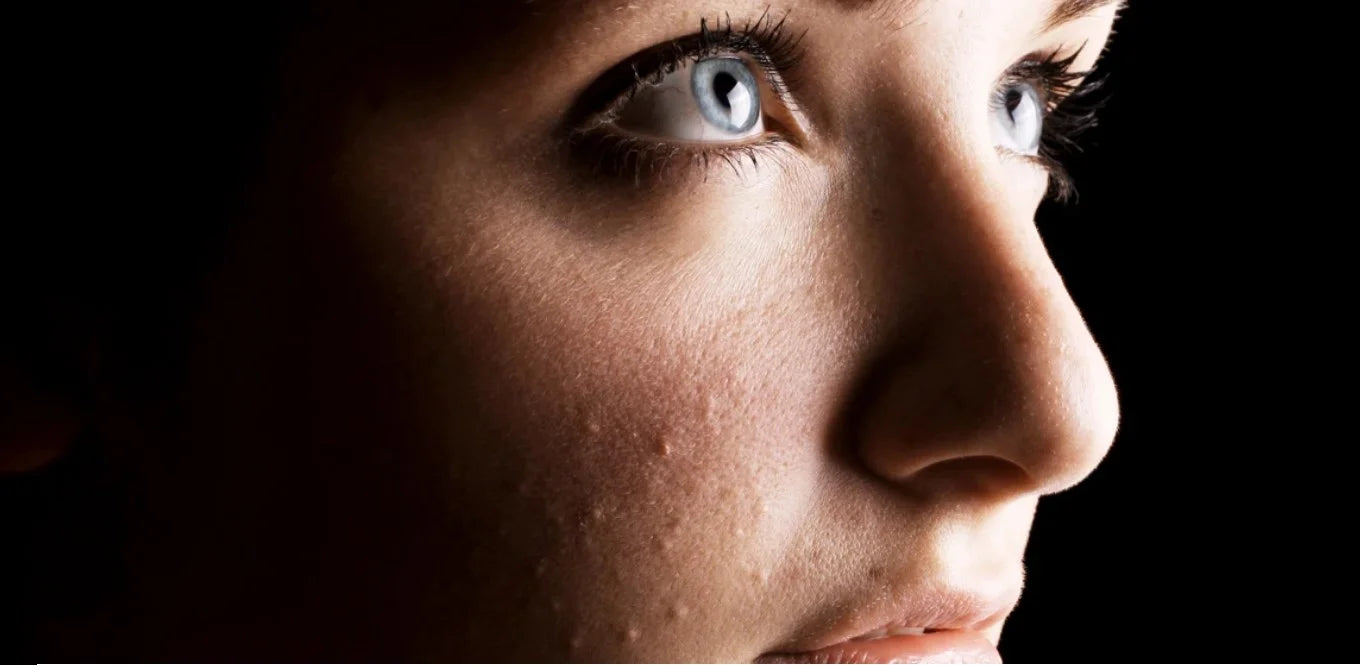 Overcome congested and acne-prone skin